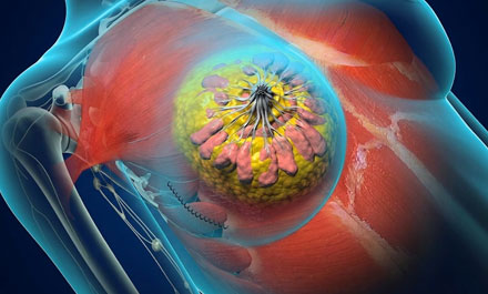 Breast Cancer Surgery