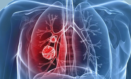 Thoracic Cancer Surgery