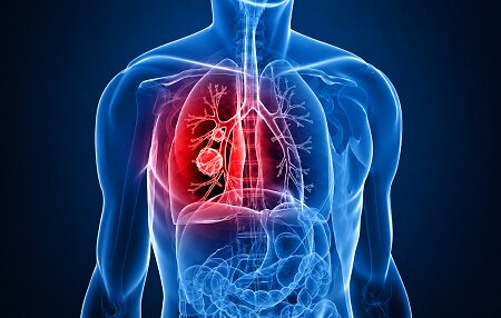 Best Lung Cancer Surgeon in Borivali - Dr. Ramkishan Nag
