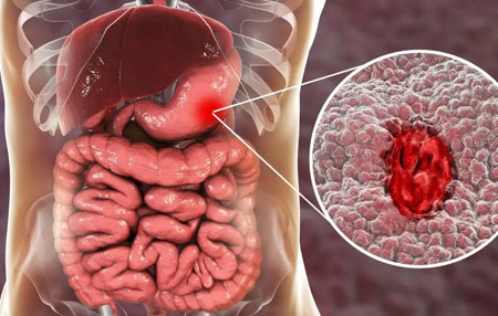 Gastrointestinal & Hepatobiliary Cancer Surgery