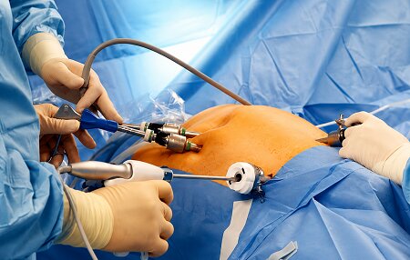 Best HIPEC Surgery in Colaba - Dr. Ramkishan Nag