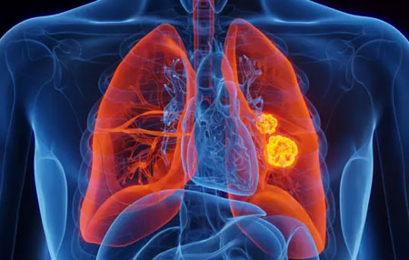 Thoracic Cancer Surgery