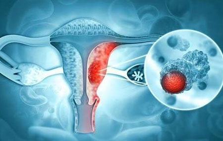 Ovarian Cancer Surgery