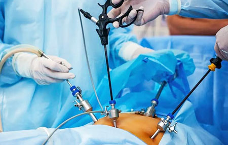 Laparoscopic Cancer Surgery
