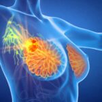 Advanced Breast Cancer Treatment In Mira Road