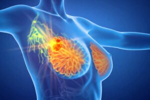 Advanced Breast Cancer Treatment In Mira Road