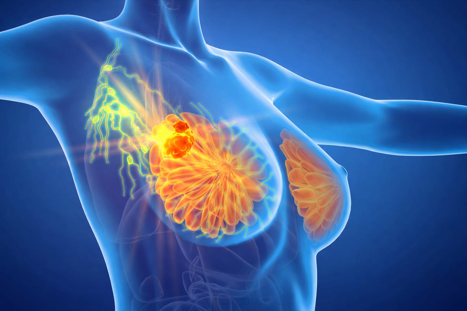 Advanced Breast Cancer Treatment In Mira Road