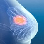 Breast Lump Removal Surgery In Mira Road