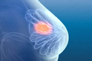 Breast Lump Removal Surgery In Mira Road
