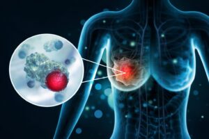 Breast Oncology Clinic In Mira Road