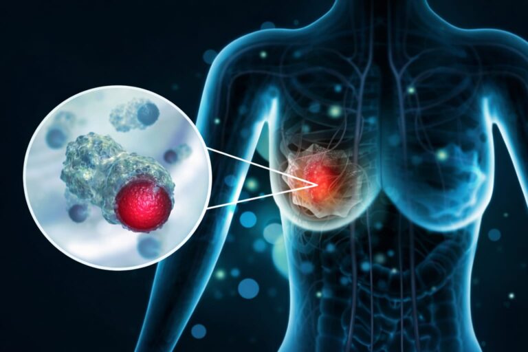 Breast Oncology Clinic In Mira Road