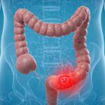 Colon Cancer Surgery In Mira Road