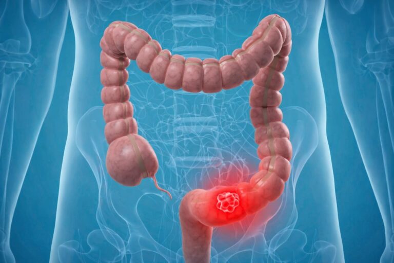 Colon Cancer Surgery In Mira Road