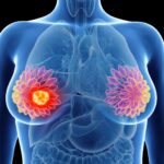 Breast Conservation Surgery In Borivali