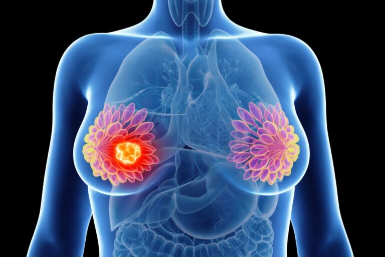 Breast Conservation Surgery In Borivali