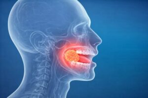 Oral Cancer Specialist In Mira Road