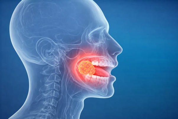 Oral Cancer Specialist In Mira Road